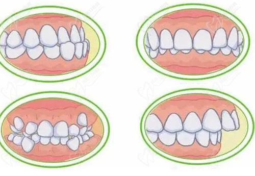 牙齿不齐