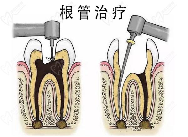 深圳根管治疗多少钱一颗2023价目表，前牙根管和后牙根管价格不同