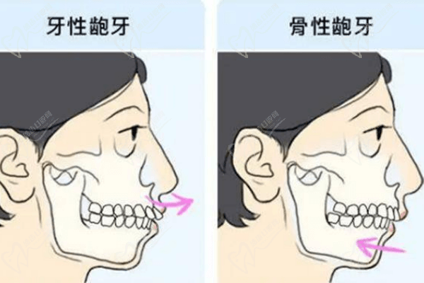 长期抿嘴会改善凸嘴吗？