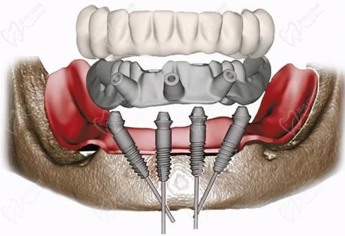 新乡固德口腔数字化种植技术