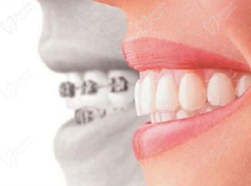 新乡固德口腔数字化矫正技术