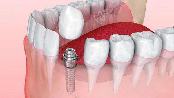 单颗牙齿缺失种植