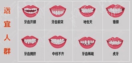 金属托槽矫正