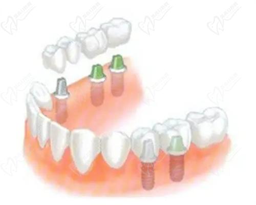 沈阳欢乐仁爱口腔种植牙价格实惠