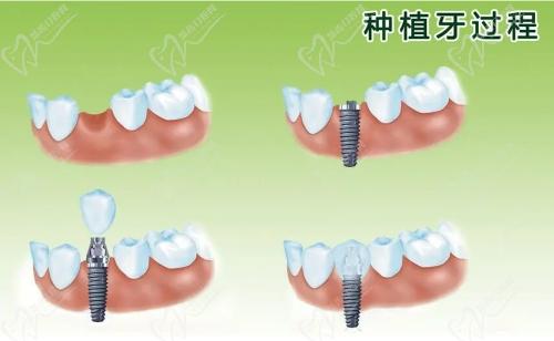 广大口腔医院种植牙技术不赖