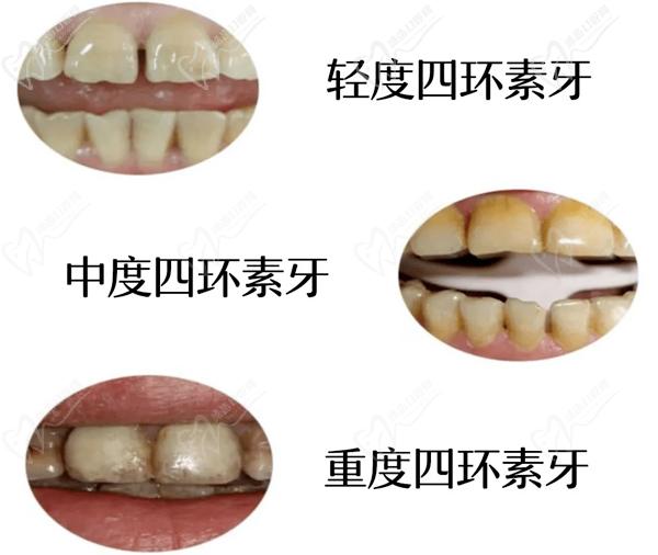 四环素牙的种类