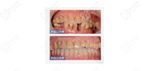 长沙美奥口腔种植牙病例