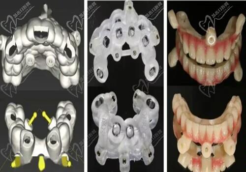 数字化牙齿种植技术.jpg