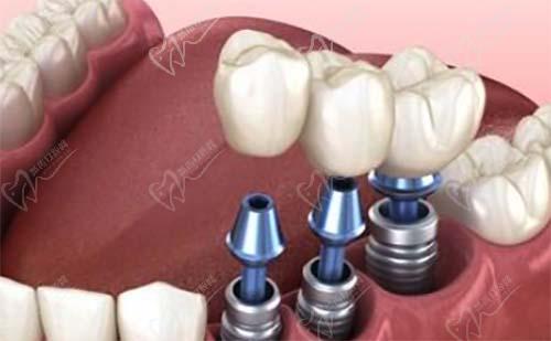 种植牙