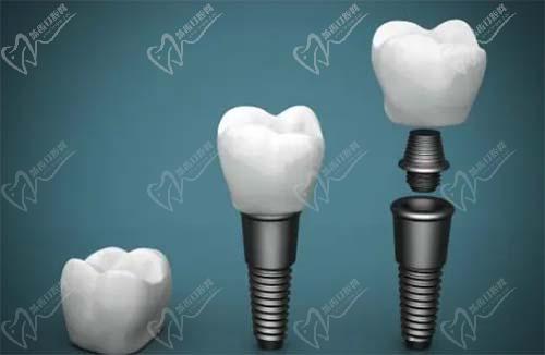 韩国登腾种植体