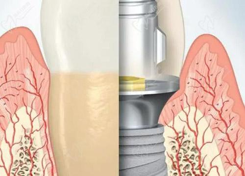 深圳麦芽口腔种植牙价格 深圳麦芽口腔种植牙价格