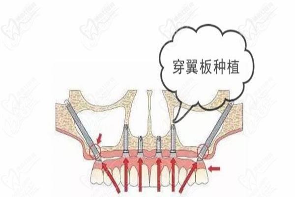 穿颧穿翼种植技术