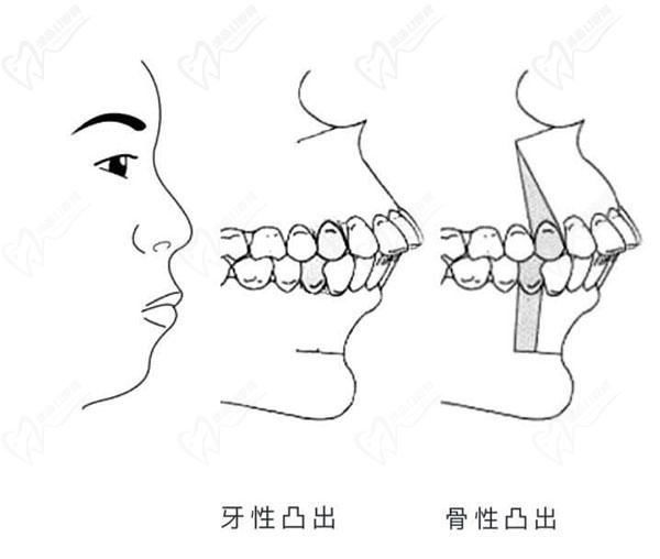 牙性和骨性突出