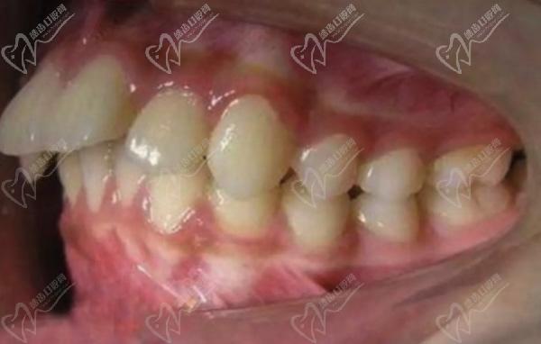 什么是骨性龅牙