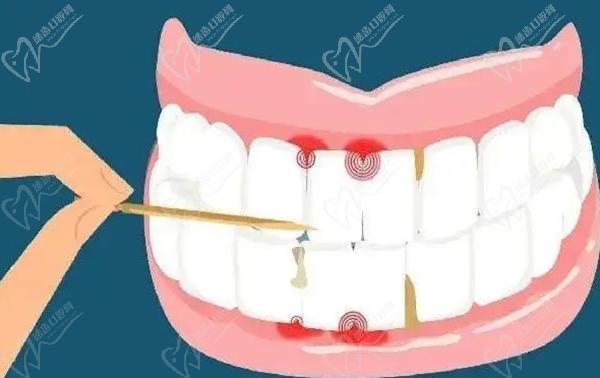 牙龈萎缩是什么