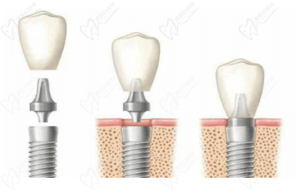 种植牙种植体