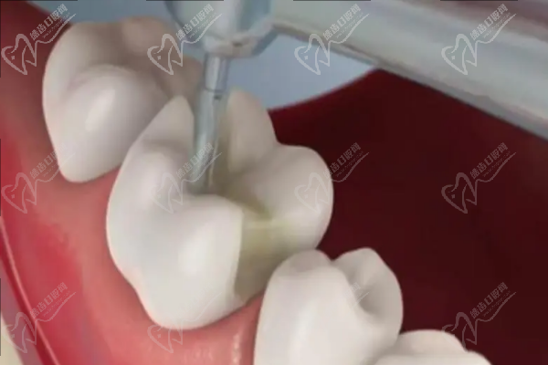 树脂补牙流程图