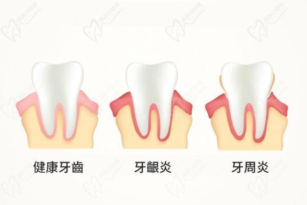 健康牙龈与牙周炎牙龈