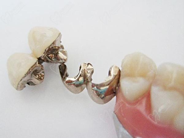 活动假牙对于健康临牙的损伤