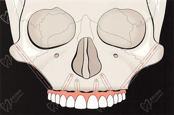 穿颧种植恢复半口牙