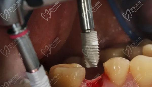 医生综合管理关系到种植牙的后期结果
