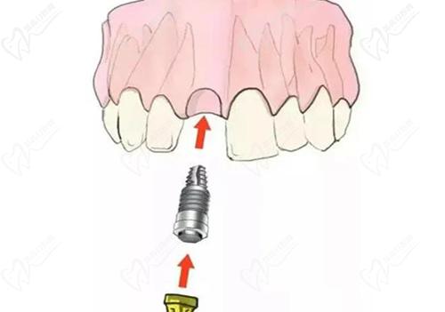 种植牙愈合基台与固定基台区别