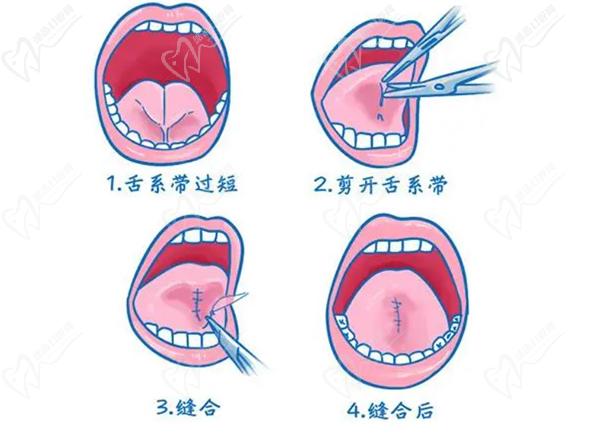 千万不要做舌系带手术，听说儿童做舌系带手术十个有九个后悔是吗