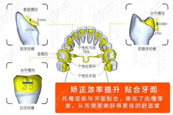 舌侧矫正原理图