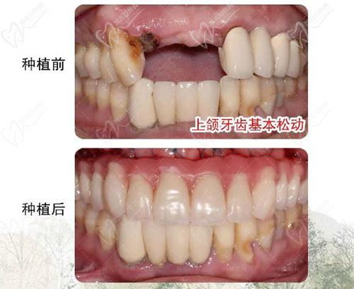 福州陈献礼种植牙技术