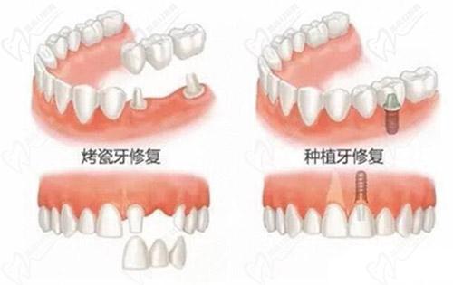 牙齿修复