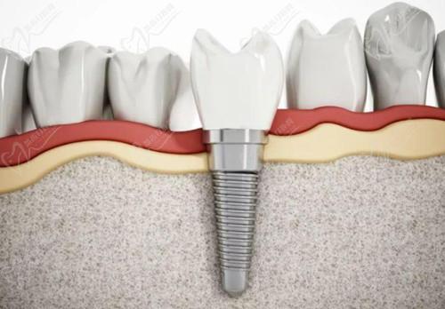 十堰胜元口腔种植牙
