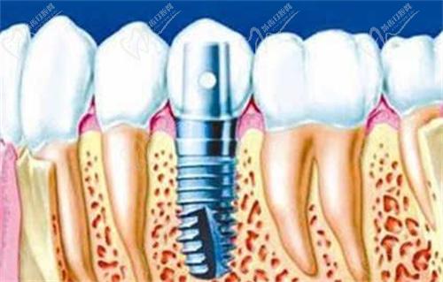 中诺口腔医院种一颗牙多少钱？