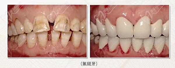 银川诺贝尔口腔医院口碑好牙冠修复