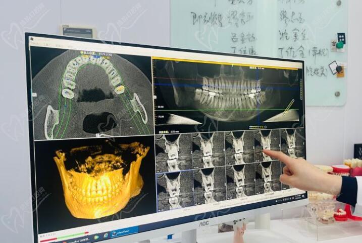 上海美奥口腔种植牙齿技术怎么样啊？