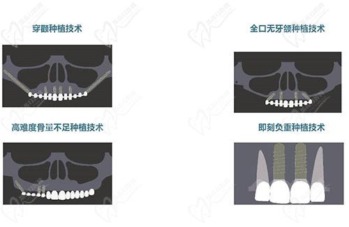 成都极光口腔种植牙技术