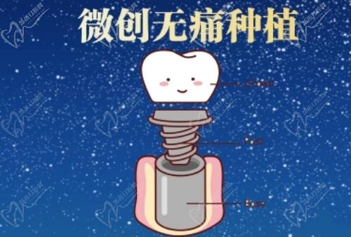南京茀莱堡口腔种植牙性价比高