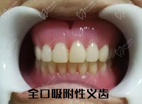 吸附式假牙的优点和缺点