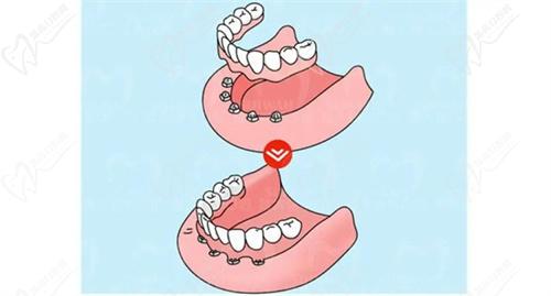 上海新菲口腔做穿颧穿翼种植技术怎么样？