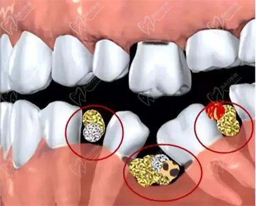 上海新菲口腔牙槽骨萎缩缺牙种植技术好