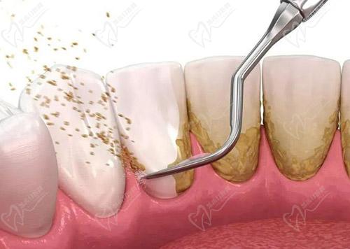十堰胜元口腔医院洗牙
