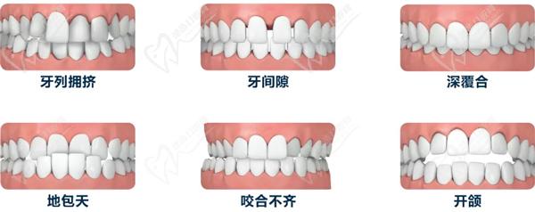 牙齿不齐的情况