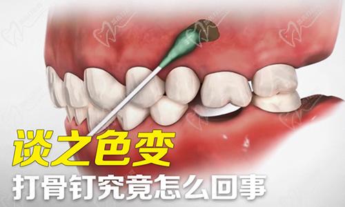 打骨钉