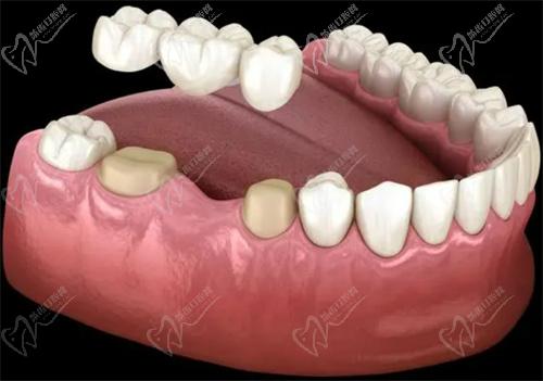 修复缺失牙齿的三种方法