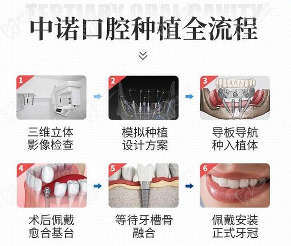 北京中诺口腔医院种植牙流程