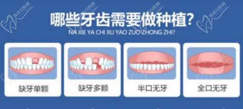 哪些人群比较适合做种植牙