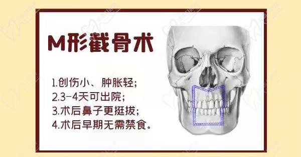 柳春明医生正颌技术优势独研M型截骨术