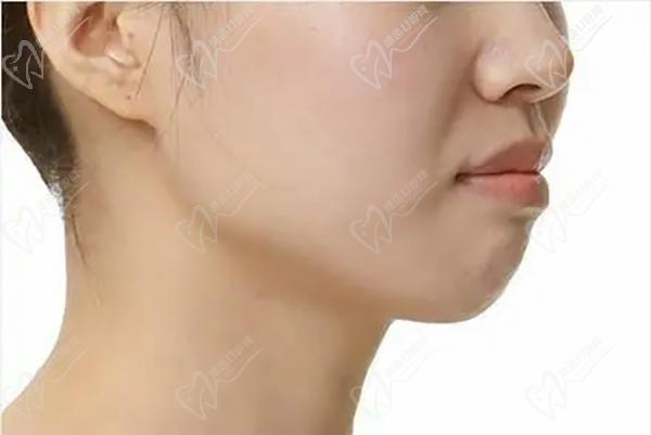 柳春明凸嘴正颌直术改善脸型、提升气质