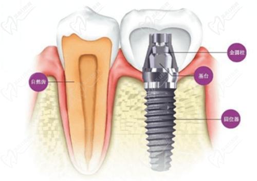 种植牙