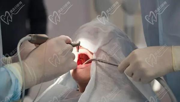 拔牙十大禁忌症八：口腔科手术后