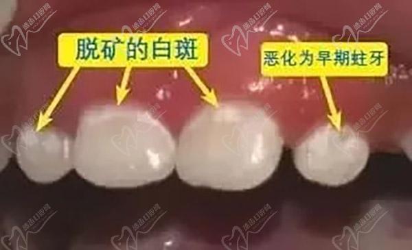 牙齿白斑